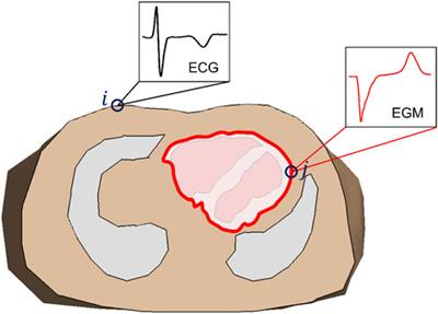 Basis and applicability of noninvasive inverse electrocardiography: a comparison between cardiac source models